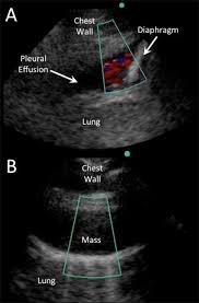 The plaps point is the most specific and sensitive view used to diagnose pleural effusion. Ultrasound In The Diagnosis And Management Of Pleural Effusions Abstract Europe Pmc