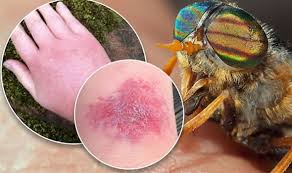 Image result for Fly Bite
