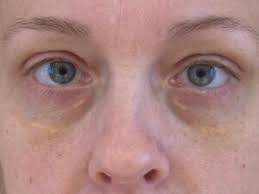 Image result for xantelasma