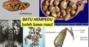 Untuk kesan lebih baik, 3 bulan akan datang detox akan di buat sekali lagi dan 6 bulan selepas itu sekali lagi. Batu Karang Batu Hempedu Elak Operet Facebook