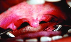 Faucial synonyms, faucial pronunciation, faucial translation, english dictionary definition of faucial. Soft Palate And Faucial Pillars Showing Redness Download Scientific Diagram
