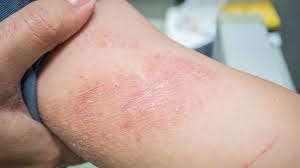 Image result for dermatitis contacta children