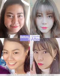 Do Not Worry Even If You Look Much Older Than Your Age Grand Can Make You Look Like Your Age Or Even Much You Nonsurgical Nose Job Liposuction Plastic Surgery