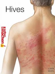 Anyone Can Develop Chronic Hives But They Re More Common In Middle Aged Women Health Conditions And Tips Pinterest Chronic Hives Urticaria An Chronic Hives Urticaria Hives Causes