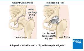 Hip Replacement And Hip Revision Health Information Bupa Uk