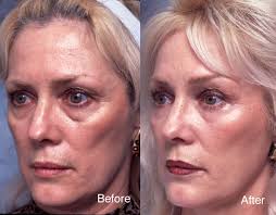 A peel can help even your skin tone. Chemical Peel Case Studies Beverly Hills Dermal Peel Studies Los Angeles