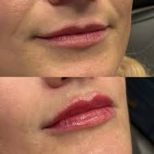 Erin Clouser RN,BSN (@erin_clouser_injects) • Instagram photos and videos