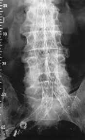 I'm a man and i love the 70's, funky music, bell bottoms, like cynthia i'm doing this on my regular jeans too, because it's impossible for a man to find a bell bottom jean (or. Bell Bottom Aortoiliac Endografts An Alternative That Preserves Pelvic Blood Flow Sciencedirect