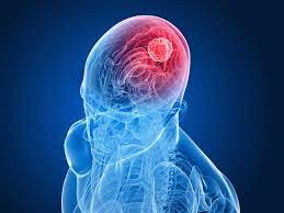 The most common brain tumor in children is medulloblastoma. Childhood Cancer Deaths Brain Cancer Overtakes Leukemia As Top Cause Live Science