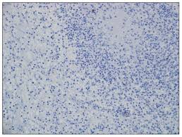 Maybe you would like to learn more about one of these? Sarcoid Like Granulomatous Reaction In Renal Cell Carcinoma Report Of A Case With Review Of The Published Reports Annals Of Saudi Medicine