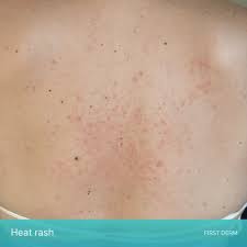 Image result for heat rash under breasts