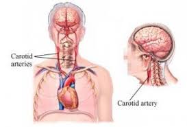 The carotid arteries are major blood vessels in the neck that supply blood to the brain, neck, and face. Neck Artery Blockage Symptoms What Is Psychology