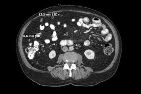 For surveillance, some authors suggest that ct should be done every 3 months for the first year after resection and then annually for the next 5 years. Cureus Benign Multicystic Peritoneal Mesothelioma Presenting As A Colonic Mass
