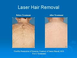 It is better to avoid using ice, but you may Laser Hair Removal Presentation Laser Hair Removal How