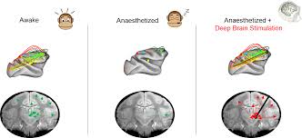 Image result for Thalamic Stimulation