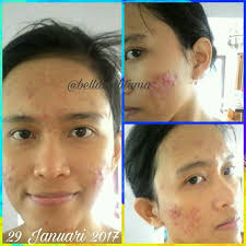 Cetaphil has over 60 years of experience at the service of skin hydration looking to simplify the way we take care of our skin. Tentang Cetaphil Yang Menyelamatkan Wajah Saya Dari Jerawat Parah Bella Zoditama