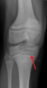 Our emf paint has been independently tested against its competitors, and it came up best for shielding and usability. Lead Poisoning Wikipedia