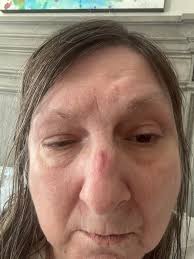 How to reduce nasal mask leakage with ResMed Airsense?