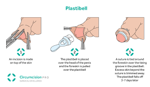 Newborn And Baby Circumcision Clinic Circumcision Pro
