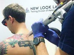 In addition to the high costs, another thing that might hold you back from becoming a laser tattoo removal technician is the individual state requirements to operate a laser tattoo removal machine. Laser Tattoo Removal Training Certifications New Look Laser College