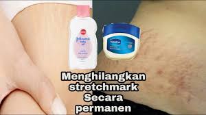 Namun, ada beberapa perawatan yang dapat membantu memudarkannya. Cara Menghilangkan Stretchmark Atau Selulit Hanya Dengan 2 Bahan Youtube