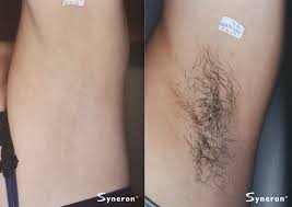 The laser inhibits the hair's ability to grow without we have the most affordable laser hair removal prices and will match any competitor's price. Laser Hair Removal In Midtown Atlanta And Alpharetta