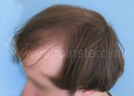 African american fue hair transplant: Male Hair Transplant