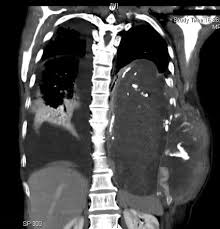 Missing quotes and pictures to show how you miss your loved ones. Empyema Necessitans Radiology Reference Article Radiopaedia Org