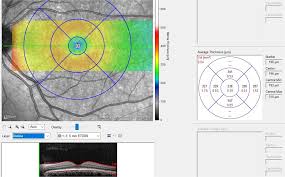 Download the document or print your pdf version. Assessment Of Inner Retina Layers Thickness Values In Eyes With Pituitary Tumours Before Visual Field Defects Occur Eye