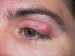 El Orzuelo Y El Chalacion Ocularis