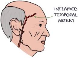 Image result for Jaw Claudication