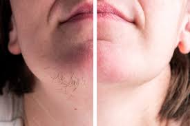 However, some women have hair on their chin, around the mouth and even on their face in general. Does Spironolactone Remove Facial Hair