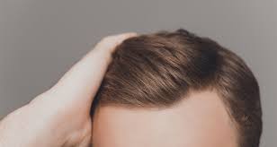 A hair transplant can only be as good as the actual hairs being transplanted, and if those hairs are very fine the doctor is faced with a challenge: How To Handle Hair Transplant Scars The Hair Clinic Malta