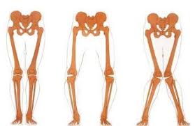 X Und O Bein Fehlstellungen Beinachsenkorrektur Hufte Knie Orthozentrum Cham Zug Schweiz Orthopadische Chirurgie Dr Med Rolf F Oetiker