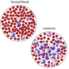 Image result for Leukemia