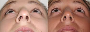 Symptoms include trouble breathing through the nose, loss of smell, decreased taste, post nasal drip, and a runny nose. Revision Rhinoplasty Nyc Dr Garrett Bennett Ny Sinus Rhinoplasty Surgeon