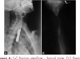 These results only indicate the perceptions of the website users. Figure 4 From Oral Manifestations Of Plummer Vinson Syndrome A Classic Report With Literature Review Semantic Scholar