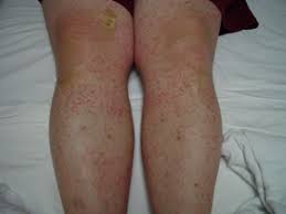 Purpura (/ ˈpɜːrpjʊərə /) is a condition of red or purple discolored spots on the skin that do not blanch on applying pressure. Iga Vasculitis Henoch Schonlein Purpura