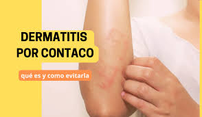 Image result for dermatitis contacta toxica