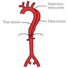 Racgp Aortic Aneurysms Screening Surveillance And Referral