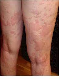Find what to do with hives. Allergic Reaction To Antibiotics Hives