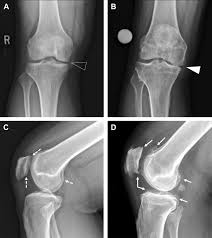 Image result for XRay Changes in Rheumatic Conditions