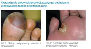 Zespół stopy cukrzycowej jest poważnym powikłaniem cukrzycy, które może prowadzić do kalectwa w wyniku amputacji. Zespol Stopy Cukrzycowej Jak Go Rozpoznac I Leczyc Rany Cukrzycowe Ortomedico Pl Realizacja Zlecen Nfz Bez Wychodzenia Z Domu