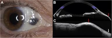 Image result for lesion sclera
