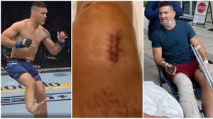 Jun 22, 2021 · former ufc middleweight champion chris weidman says he is confident he will fight again after breaking his leg against uriah hall at ufc 261. Bone Went Through Skin Ufc S Chris Weidman Shows Scars From Horror Leg Injury As He Reassures Fans I Will Be Good Graphic Rt Sport News