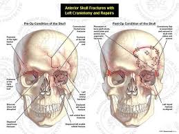 This Exhibit Depicts Anterior Fractures Of The Skull With A Subsequent Left Craniotomy And Repairs Pre Ope Medical Illustration Medical Art Displaced Fracture
