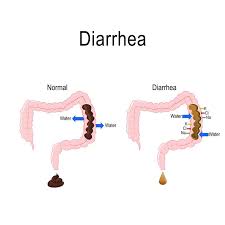 Your doctor can determine whether the diarrhea is caused by a more serious condition, and can recommend treatment. Diarrhea Guide Causes Symptoms And Treatment Options