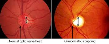 Image result for Acute Vision Loss