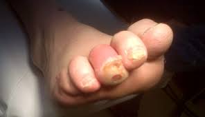 Image result for Skin Ulcer