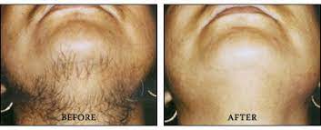 Permanent laser hair removal treatment chicago all skin types. Permanent Laser Hair Removal Reduction In Chicago Illinois Advanced Laser Clinics